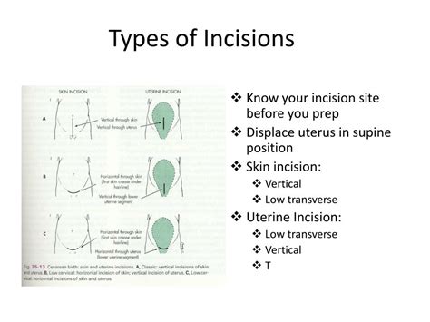 Types Of Surgical Incisions Medical Anatomy Emergency Vrogue Co