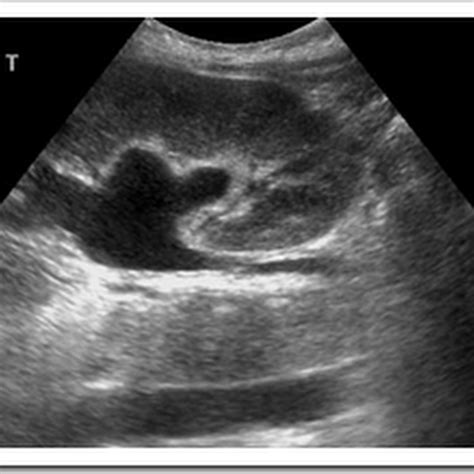 Ultrasound Images Of Case Nephrostomy Radiology Imaging