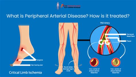 What Is Peripheral Arterial Disease How Is It Treated Dr Abhilash