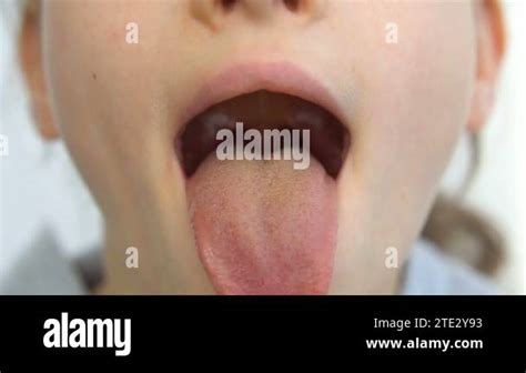 Wide Open Mouth With A Tongue Stuck Out View Of The Uvula And The Soft