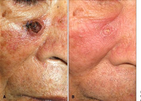 Figure 3 From Treatment Of Keratoacanthoma With 5 Imiquimod Cream And