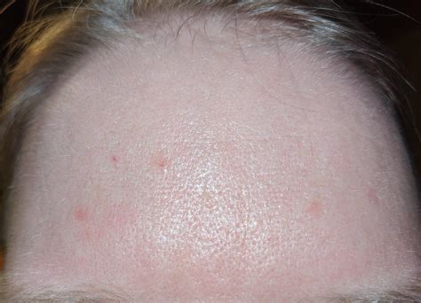 Skin Concern Why Is Only My Forehead Reacting Red Bumpy Routine