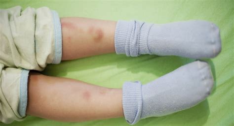 Bruises On Toddlers Babycenter