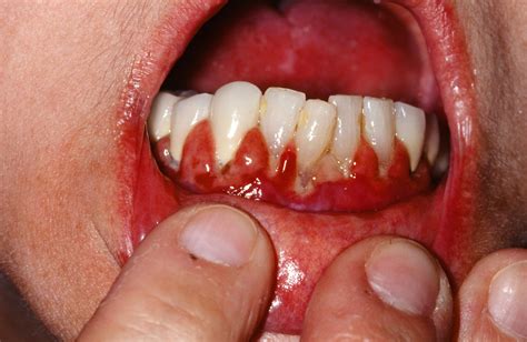 Oral Lichen Planus Causes Symptoms Prognosis Diagnosis Treatment