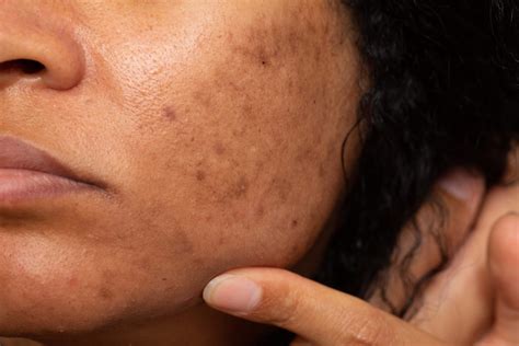 Las Manchas De Tu Cara ¿son Melasma Ferbos Medic