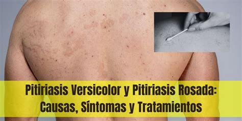 Pitiriasis Versicolor Y Rosada Causas Síntomas Y Tratamientos