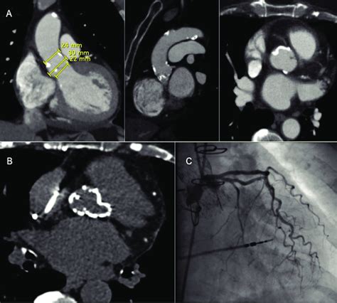 A Preoperative Ct Showing Aortic Root Calcification And An Annular