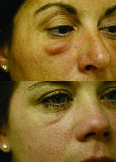 How Long Swelling After Dermal Fillers Wallpaperist