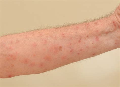 How Do You Get Scabies Causes Symptoms Treatment Pictures