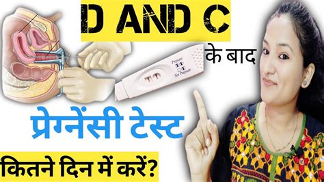 D And C Ke Kitne Din Baad Pregnancy Test Karna Chahiye When To Take A Pregnancy Test After D