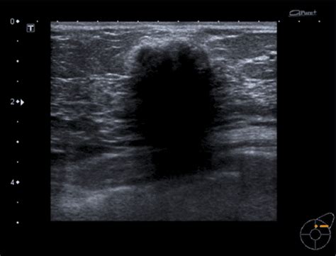 Figure 7 From Ultrasound Of Non Neoplastic Breast Lesions With