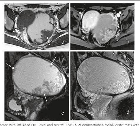 Mri For Differentiating Ovarian Endometrioid Adenocarcinoma From High