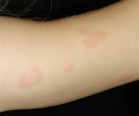 Does This Look Like Ringworm Babycenter