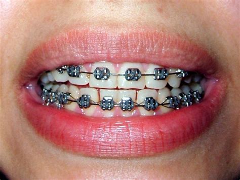 Train Track Braces Orthodontics In London Braces Teeth Colors Braces Colors Dental Braces