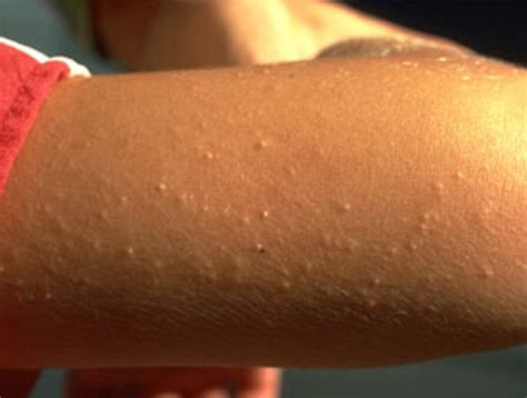 Uncovering The Potential Of Vitamin E For Treating Keratosis Pilaris Scars Eadvvienna Org