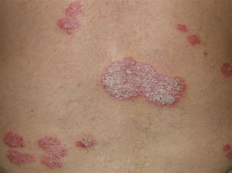Chronic Plaque Psoriasis An Overview Of Treatment In Primary Care