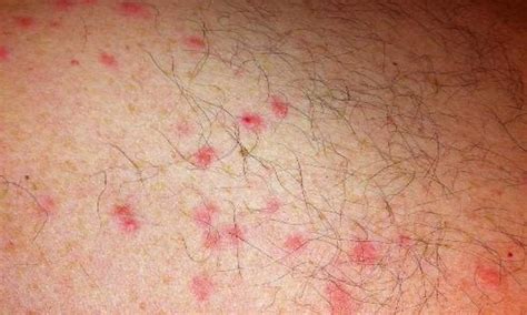 What Does Scabies Rash Look Like