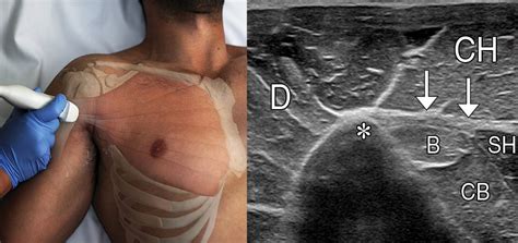 Us And Mr Imaging Of Pectoralis Major Injuries Radiographics Images And Photos Finder
