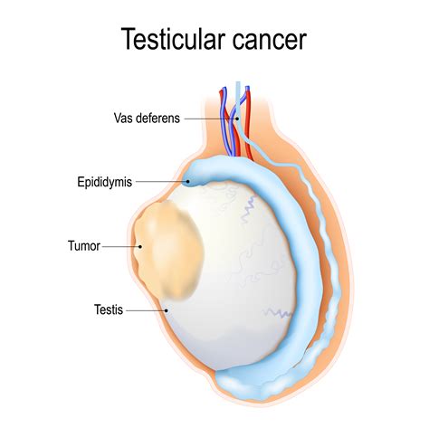 Risk Factor And Causes Of Testicular Cancer