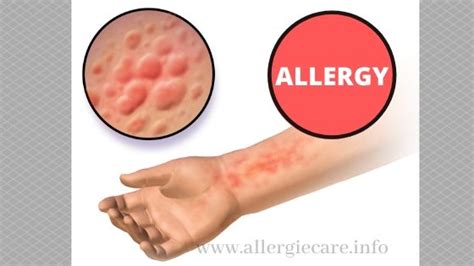 The Allergy You Should Know All About It Allergie Care