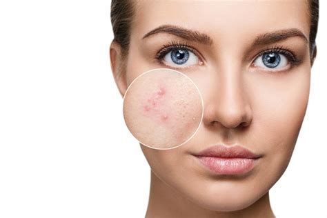 How To Treat Skin Redness Skin Redness Causes Photos And Treatments