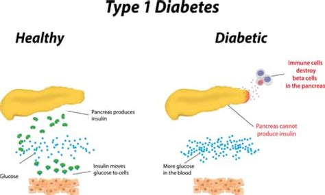 What You Should Know About Type 1 Diabetes Kars4kids Parenting