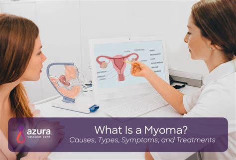 Myoma The Causes Types Symptoms And Treatments