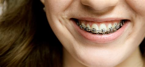 Nhs Treatments The Specialist Orthodontic Practice