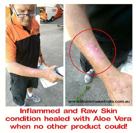 Aloes In The Treatment Of Burns And Scalds Aloe Vera Australia