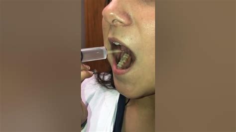 Irrigation Of Wisdom Tooth Sockets Youtube