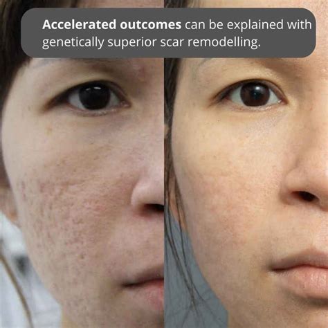 Best Acne Scar Treatments In Australia Dr Davin Lim