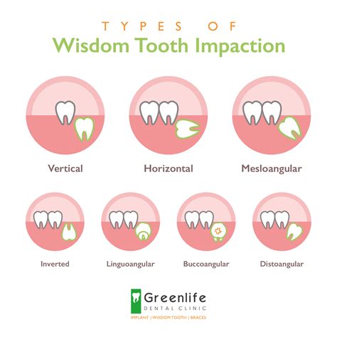 What Are The Different Kinds Of Wisdom Tooth Impaction Greenlife Dental