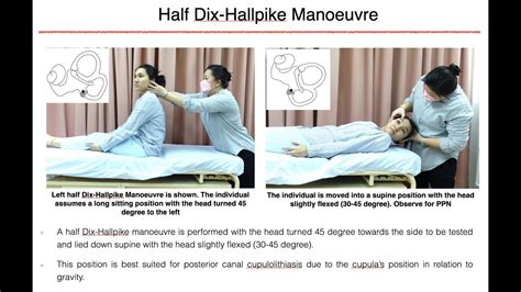 Half Dix Hallpike Manoeuvre Youtube