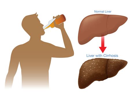 Alcohol Related Liver Disease Early Signs Treatment And Prevention