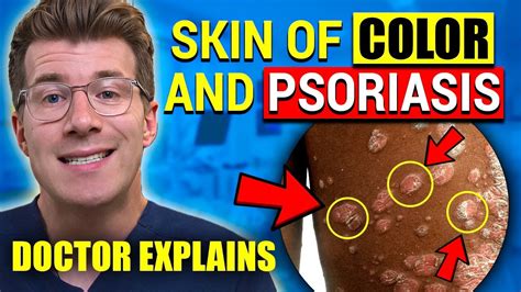 Skin Of Color And Psoriasis Visual Signs And Symptoms Doctor Explains