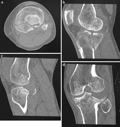 A Posterior Inverted L Shaped Approach For The Treatment Of Posterior