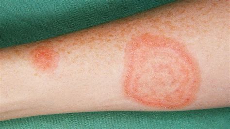 Knowtopic Com Skin Rashes Common Types And Causes Riset