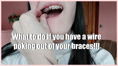 Have A Wire Poking Out Of Your Braces Here S What To Do Youtube