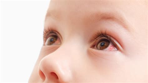 Conjunctivitis In Toddlers Causes And Treatment Toddler Mother And Baby