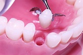 What Are Maryland Dental Bridge Pros and Cons? | CARDS DENTAL