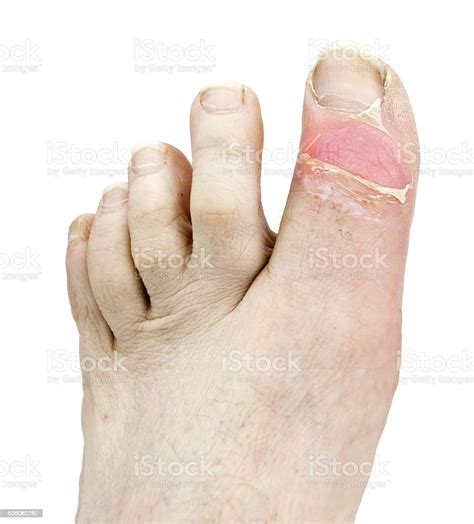 Inflamed Gout Toe Stock Photo Download Image Now Gout Adult