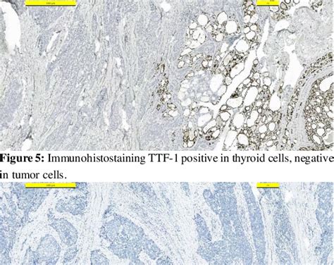 Figure 5 From Carcinoma Showing Thymus Like Differentiation Castle A