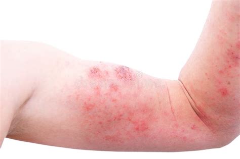 O An Ncio Da Dermatite At Pica Igualmente Conhecido Como A Eczema At Pica Um Tipo De