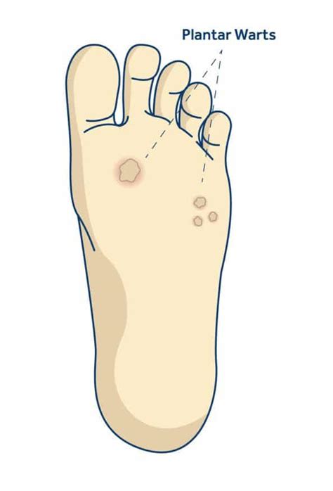 Plantar Warts Shellharbour Podiatry Your Local Podiatrists