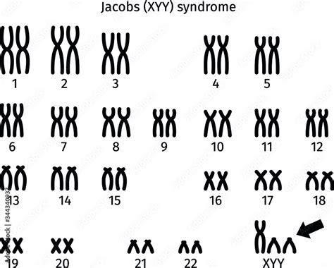 Scheme Of Jacobs XYY Syndrome Karyotype Of Human Somatic Cell 47XYY