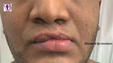 Bilateral Cleft Lip Revision With Muscle Repositioning And Scar Removal