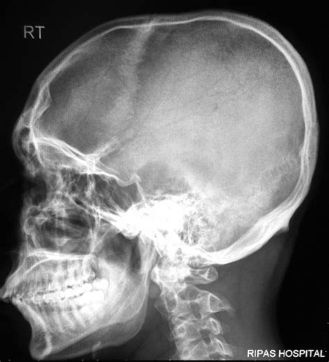 Skull Fractures Neuropedia