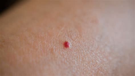 Cherry Angioma Symptoms Causes And Treatment Dermavel