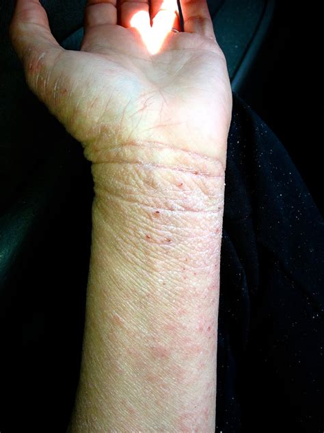 Scratching The Surface Of Topical Steroid Withdrawal 8 Months Of