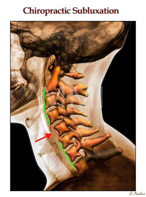 3 D Color X Ray Chiropractic Cervical Spine Subluxation Subluxation
